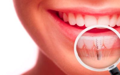 Implantes dentales, ¿que debemos saber antes de elegir donde colocarnoslos?