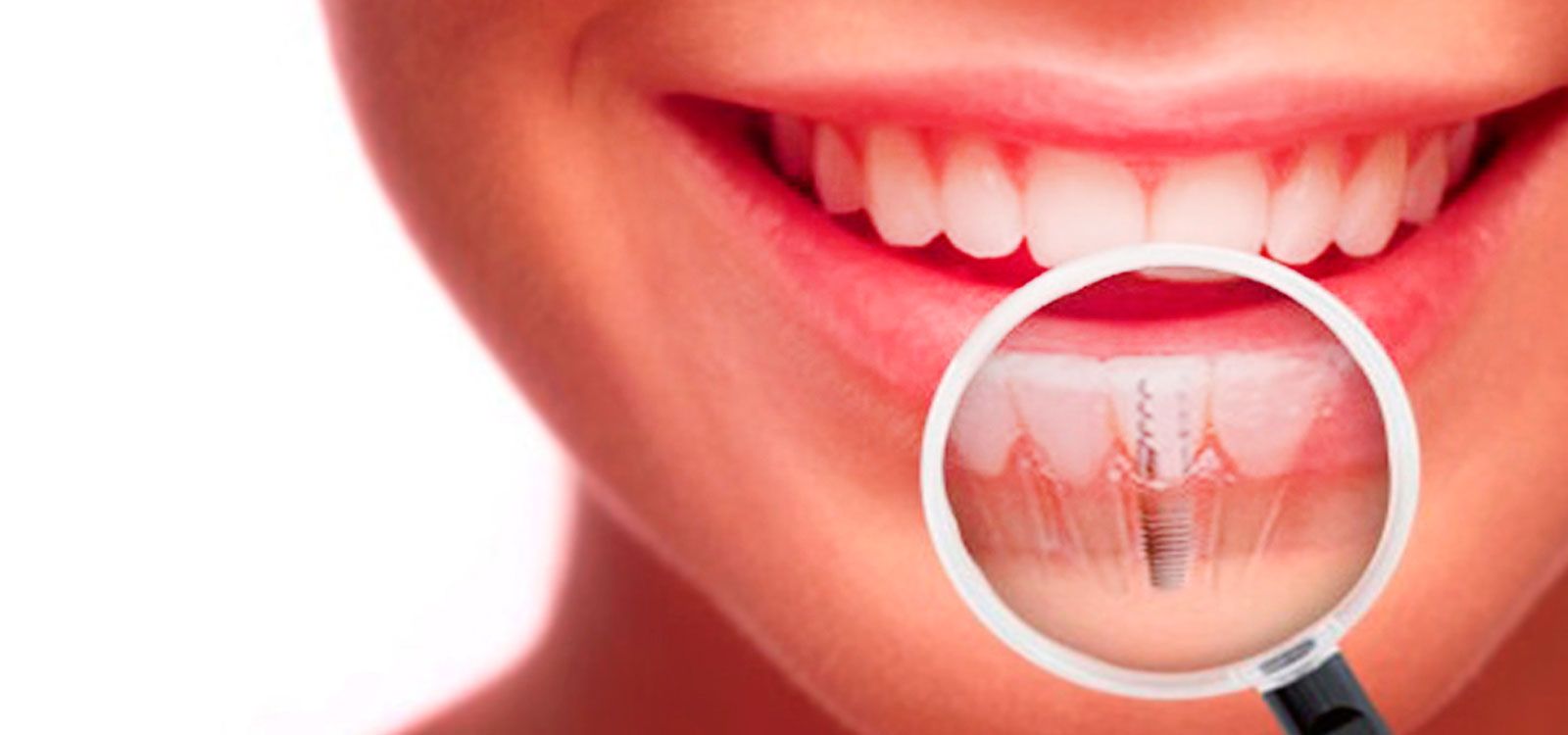implantes dentales en madrid