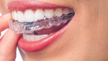 Dentistas, Ortodoncia Invisible