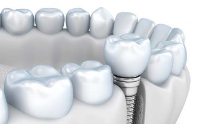 Implantes dentales en Madrid centro,