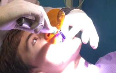Empastes dentales sin mercurio, En Dental Denche