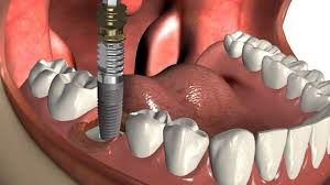 Dental Denche implantes en madrid