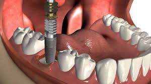 Implantes dentales, que debemos tener en cuenta, Dental Denche implantes dentales en Madrid
